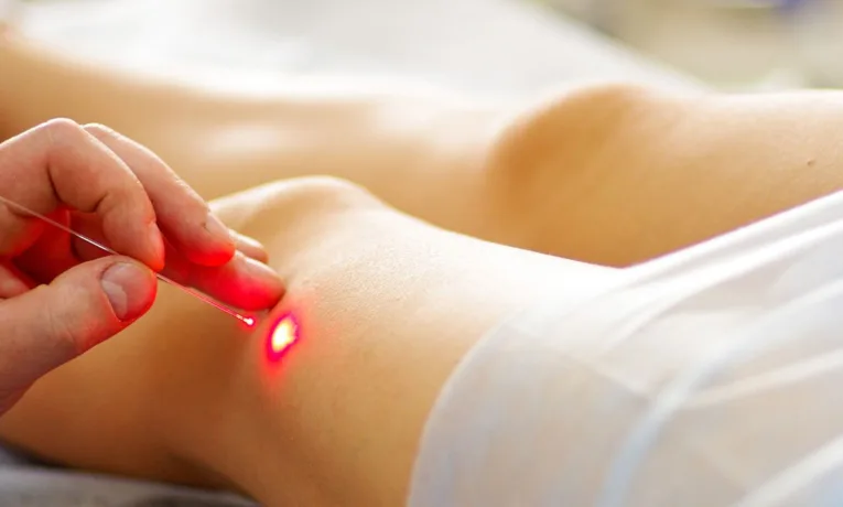 лазерна операція варикозу ціна