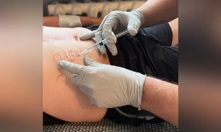 “Це зробив хірург” — медик про напис “Слава России” на тілі звільненого з полону воїна. Львівські лікарі вже почали його видаляти