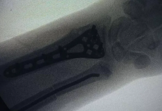 Львівські лікарі виправили деформовану руку підлітку, який три місяці мовчав про перелом