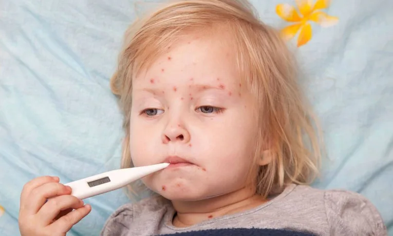 У 2025 році на Львівщині зафіксували у 9 разів більше випадків кору ніж за цей період минулоріч