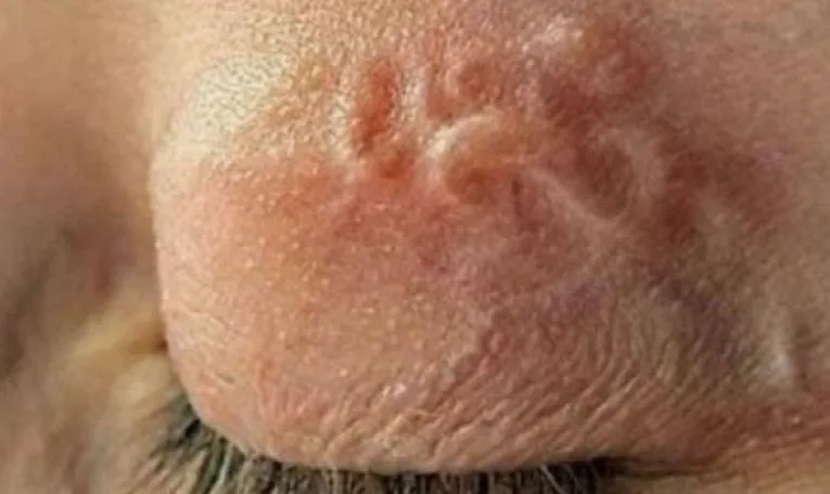 З ока львів’янина хірурги видалили 12-сантиметрового паразита