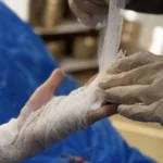 Львівські лікарі врятували пальці директорці ліцею після важкої травми на зіплайні за кордоном